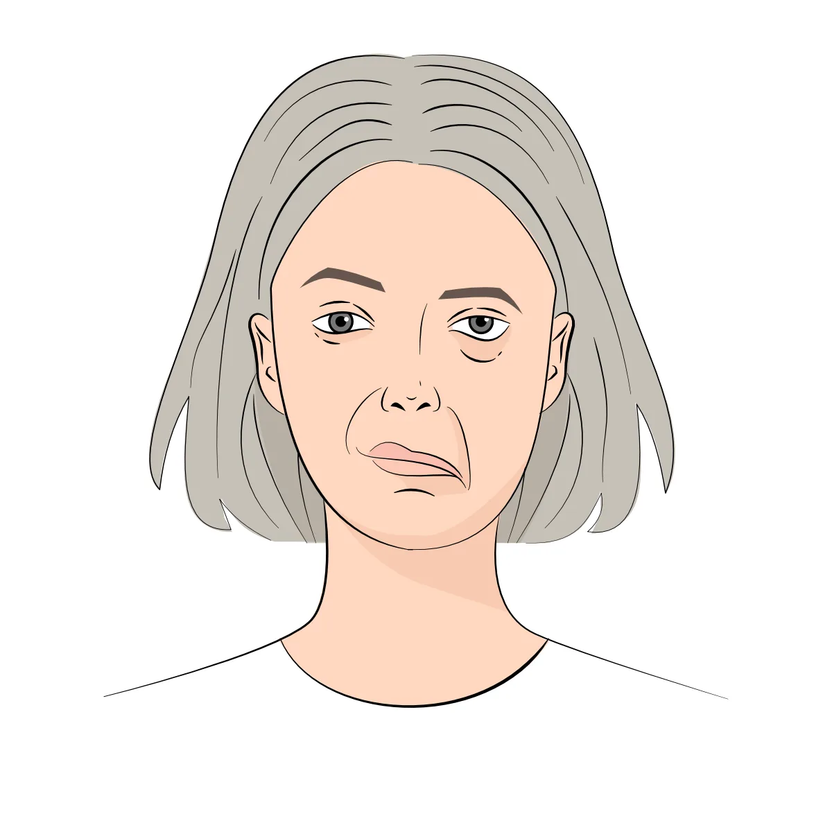 Facial Palsy NZ Palsy face female
