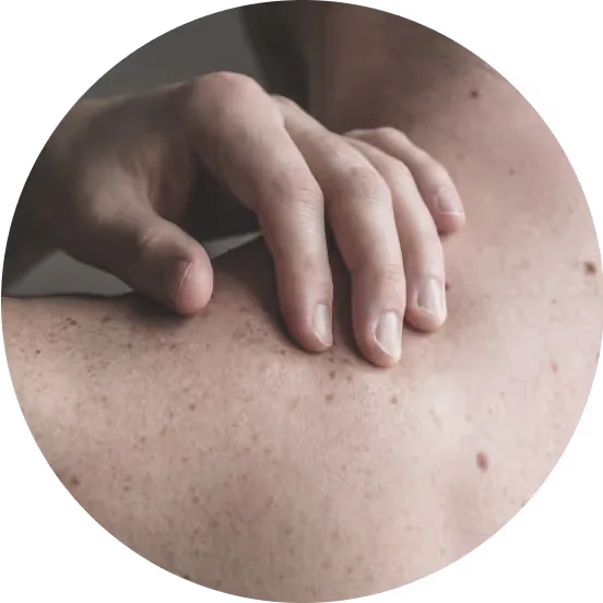 Bay Surgery Skincancer
