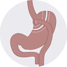 Bay Surgery Bypass