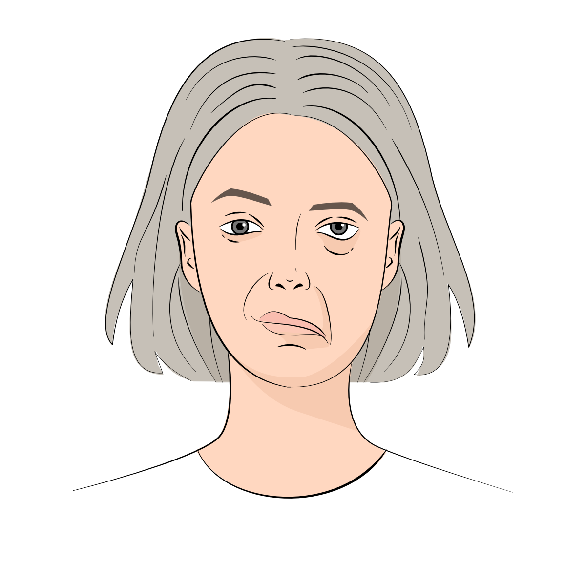 Facial Palsy NZ Palsy face female